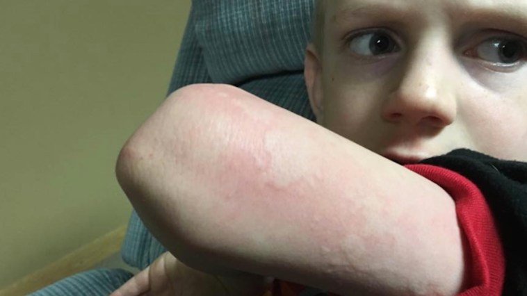 Yes, Hives Could Easily Be A Symptom of The Flu!