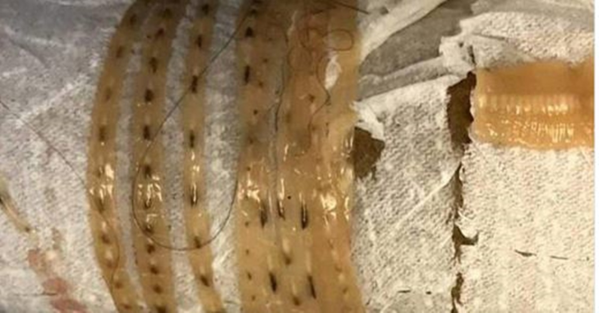 giant tapeworm Archives - Rare