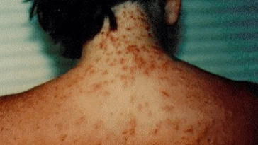 Sea Lice Florida Panhandle