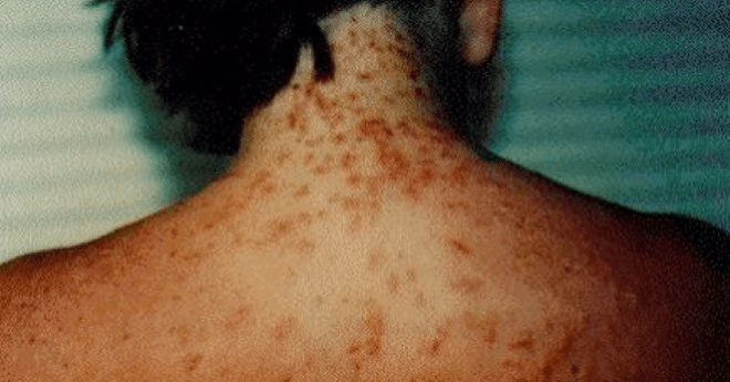 Sea Lice Florida Panhandle