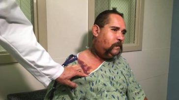 Arizona Man Bit Face Rattlesnake BBQ