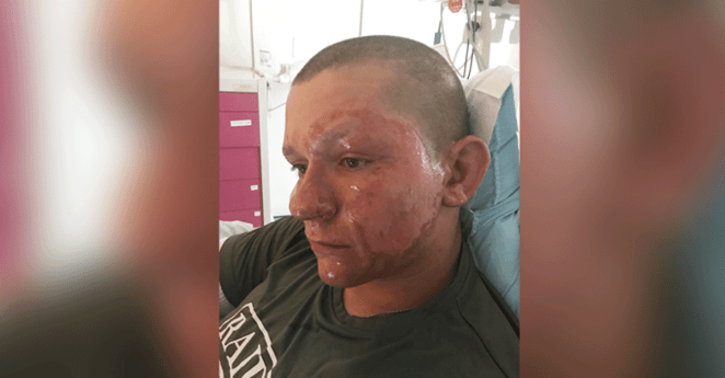 Giant Hogweed Burns Face