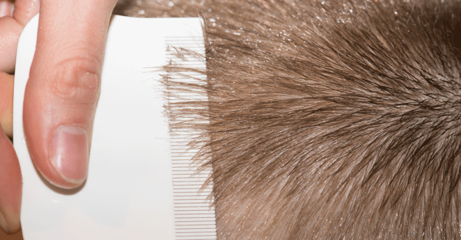 Map Lice Resistant Normal Treatment