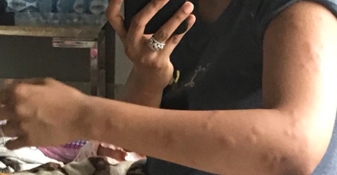 Air India Passengers Complain of Bed Bug Bites