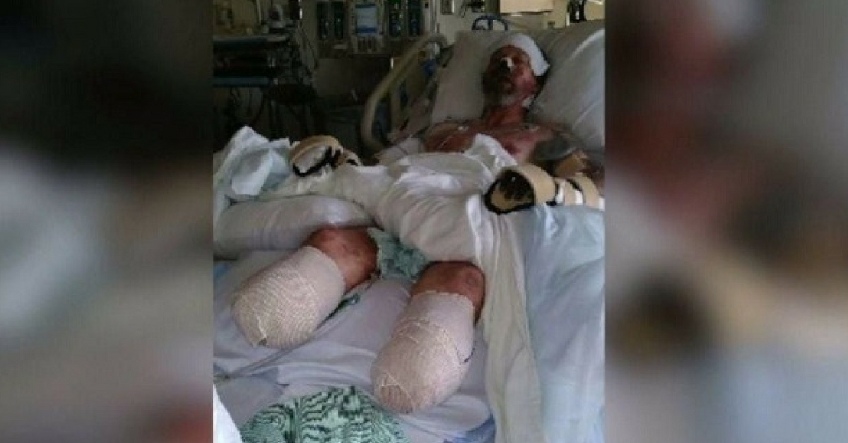 Wisconsin Man Looses Limbs From Dogs Saliva That Led To Rare Infection