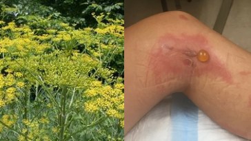 Wild Parsnip Plant Causes Second-Degree Burns On Vermont Woman
