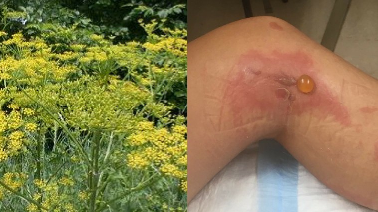 Wild Parsnip Plant Causes Second-Degree Burns On Vermont Woman
