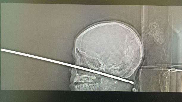 10-Year-Old Boy Survives After Falling Face First On Metal Meat Skewer