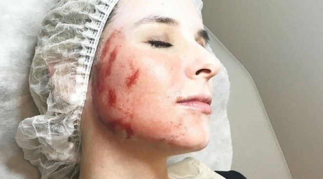 'Vampire Facial' Clients Urged to Test for HIV and Hepatitis