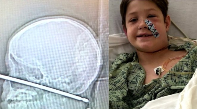 10-Year-Old Boy Survives After Falling Face First On Metal Meat Skewer