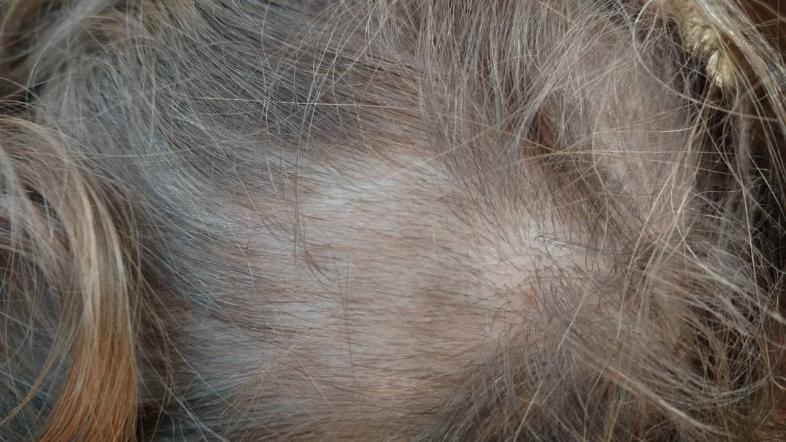 Parents Upset After Hair Chunks Were Taken From Students For Random Drug Testing