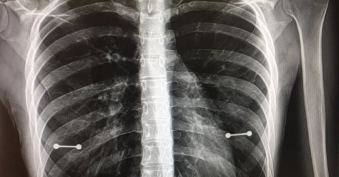 Pierced Nipples X-Ray