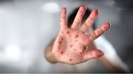 Measles Outbreak Reported in New York and New Jersey