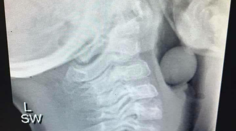 Terrifying X-Ray Shows Why Toddlers Should Never Eat Grapes Without Supervision