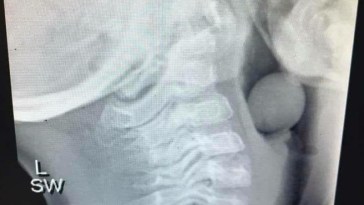 Terrifying X-Ray Shows Why Toddlers Should Never Eat Grapes Without Supervision