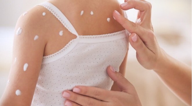 Parents Are Organizing "Chickenpox Parties" To Intentionally Share The Disease