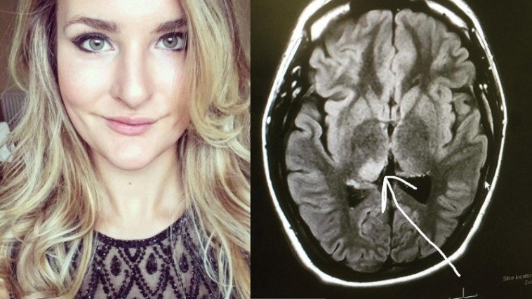 Nurse Diagnoses Her Own Brain Tumor After Seeing Posters at Work