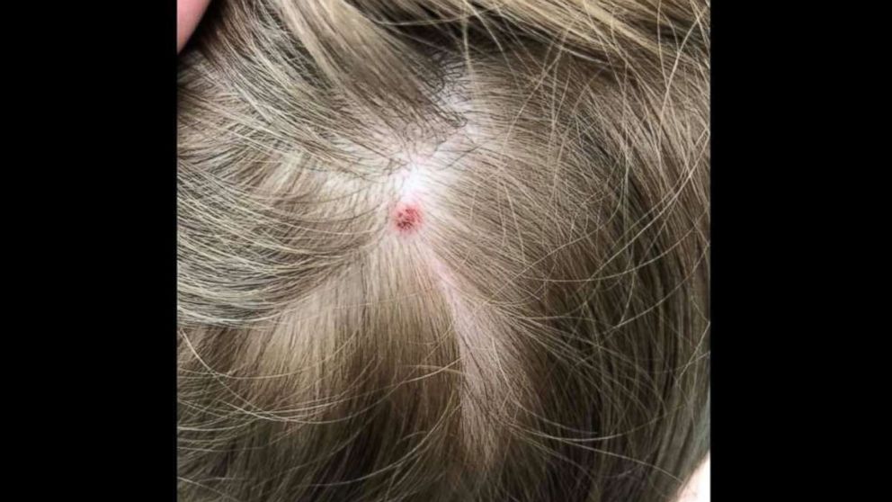 5-Year-Old-Girl Suddenly Paralyzed from Unknown Tick Bite
