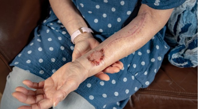 Women Gets New Tongue Made From Arm After Battling Cancer