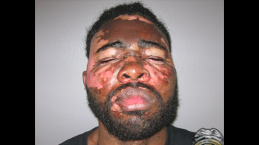 Burglar Burned Hot Grease