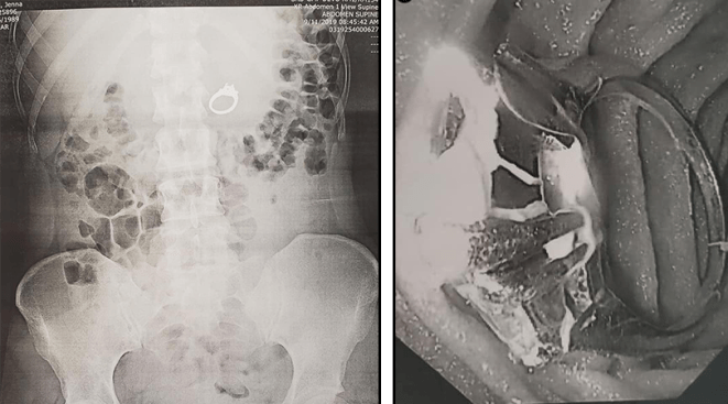 Sleep-Eating Engagement Ring