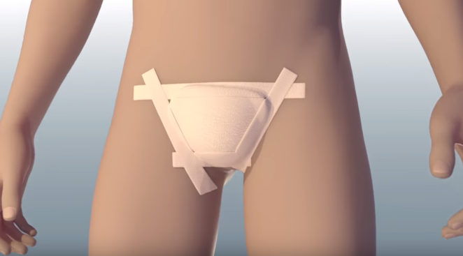 Veteran Penis Transplant