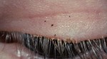 eyelash lice
