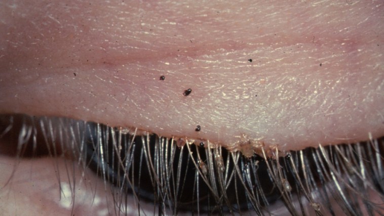 eyelash lice