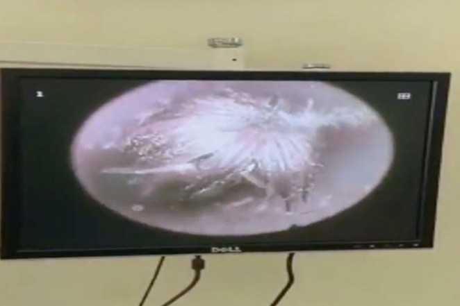 Caterpillar Ear Canal