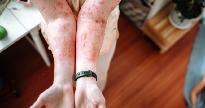 Woman Died Of Mystery Illness