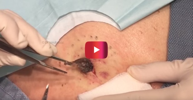 What a doctor pulled out of his back will remind you of that infamous scene from “Alien”