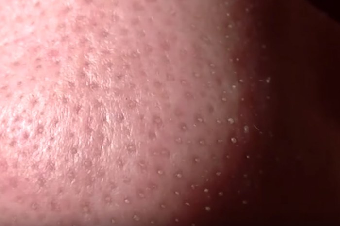 This man’s nose was bursting with clogged pores, but he pulls a strip away — what a relief