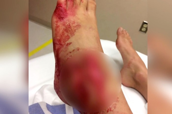 An 11-year-old girl’s entire foot found its way into a fish’s mouth, and 25 razor-sharp bites soon followed