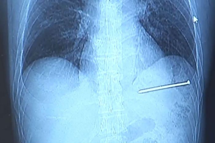 This Guy Accidentally Shot Himself In The Heart With A Nail Gun and Then Drove Himself to The Hospital