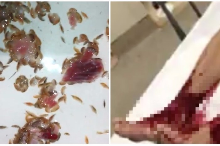 A teen got out of the water to find his feet chewed up and bleeding — and the cause is as gross as can be