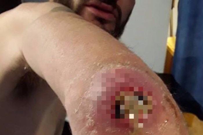 The gaping, gooey hole left in a man’s elbow by a spider bite is the stuff of nightmares