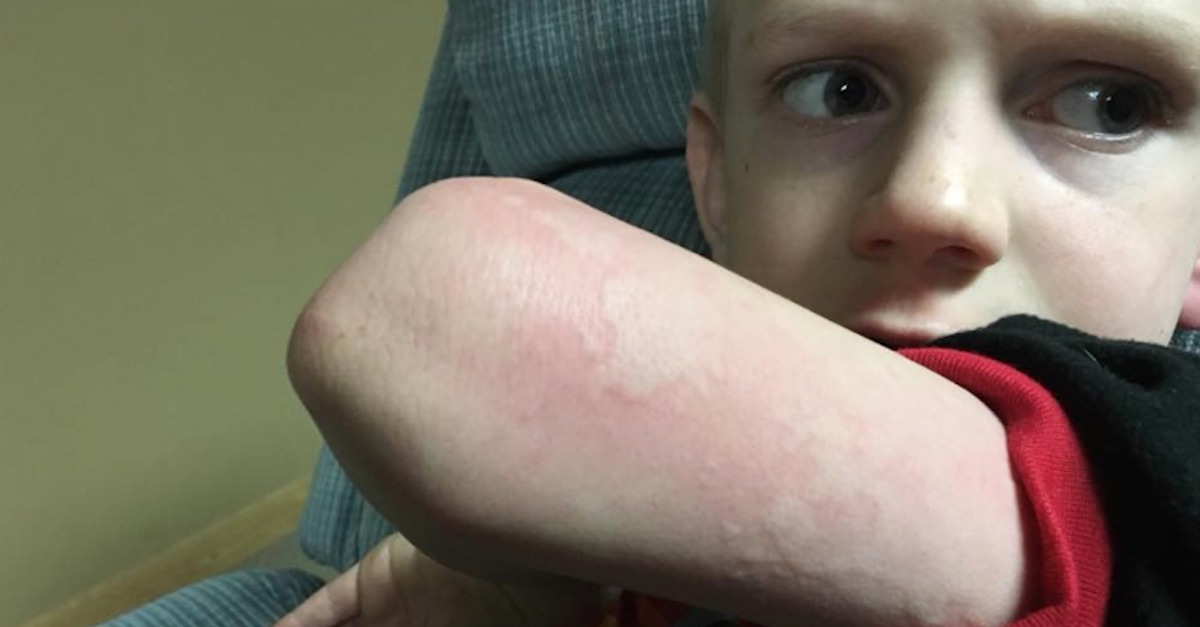 Flu Shot Rare   Rash 