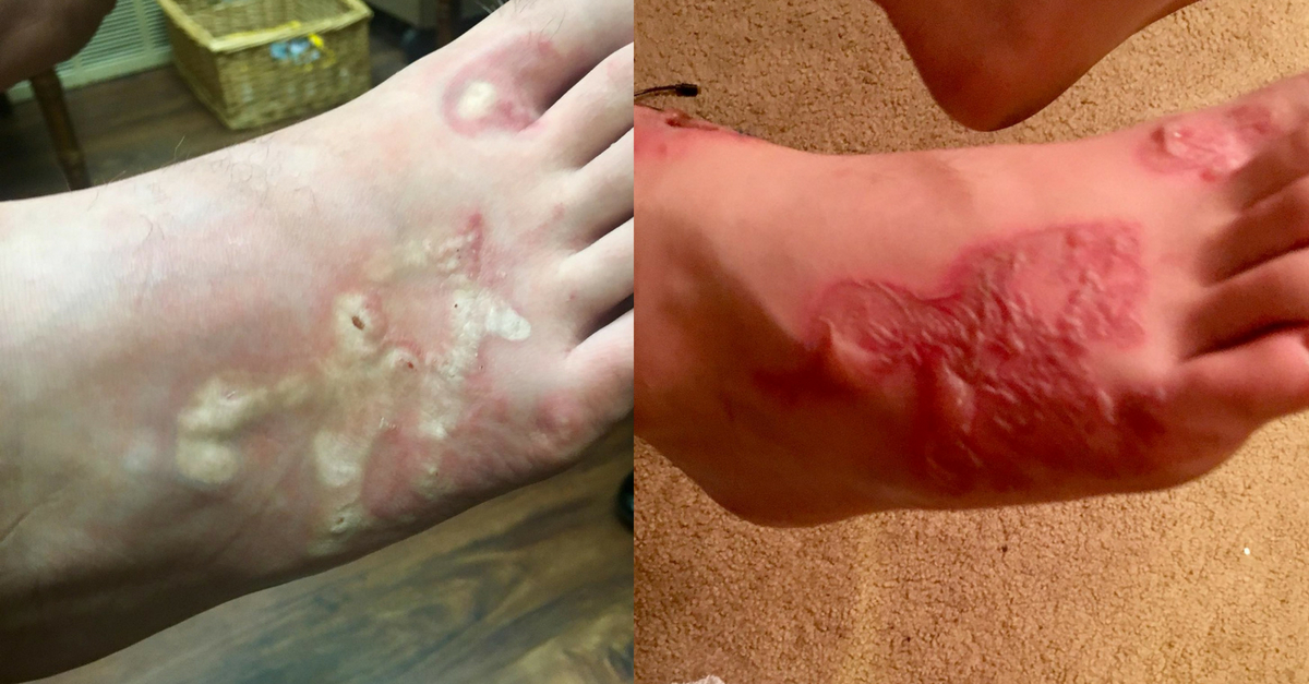 Teen Gets Gruesome Hookworm Infection At Beach During Mission Trip | Rare