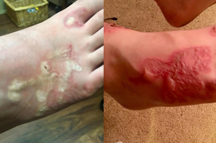 Teen Gets Gruesome Hookworm Infection At Beach During Mission Trip