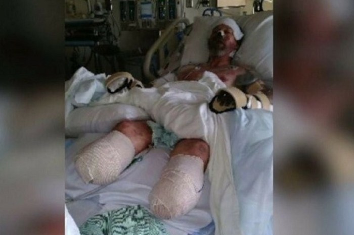 Man Loses Limbs From Dog Saliva That Led To Rare Infection