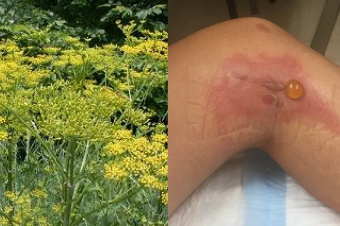 Roadside Plant Causes Second-Degree Burns On Vermont Woman