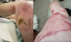 Man Suffers Acid Burns After Vape Pen Explodes Inside His Pocket