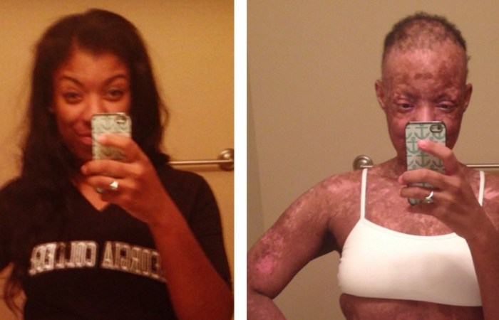 Woman’s Skin ‘Melted Off’ After Doctor Prescribed Wrong Medication