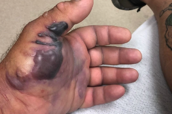 Flesh Eating Bacteria Nearly Rots Man’s Arm Off After Fishing Trip