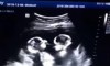 Identical Twins Spotted ‘Fighting’ In Mother Womb During Ultrasound