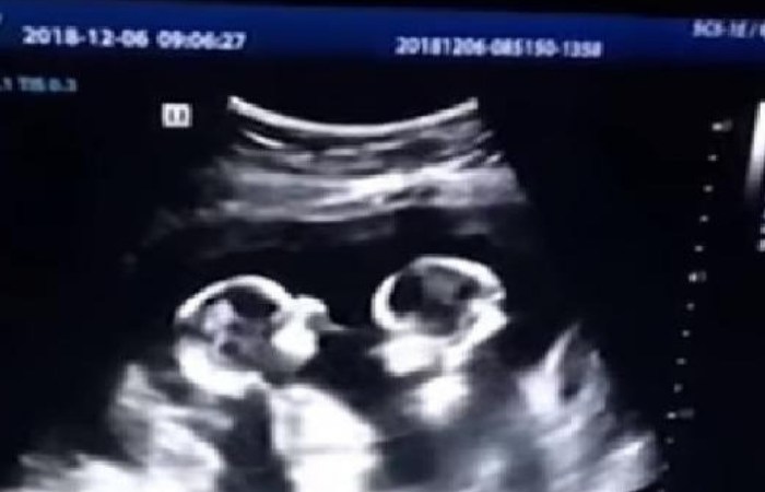 Identical Twins Spotted ‘Fighting’ In Mother’s Womb During Ultrasound