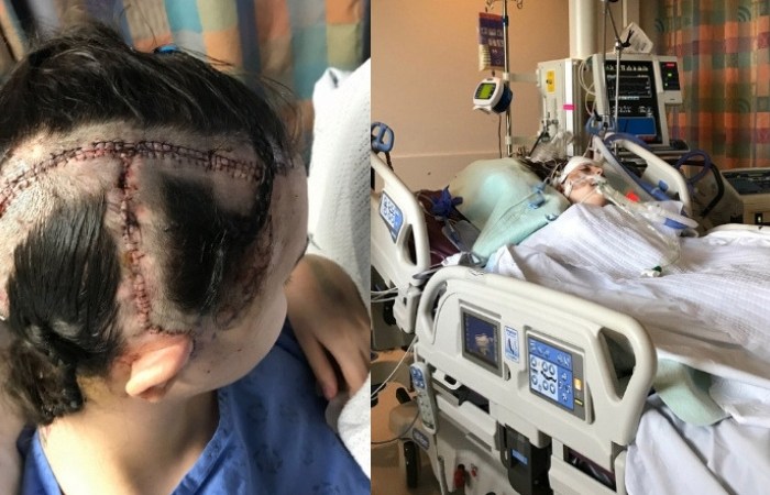 Woman Miraculously Survives After Her ‘Brain Explodes’ Due To Aneurysm