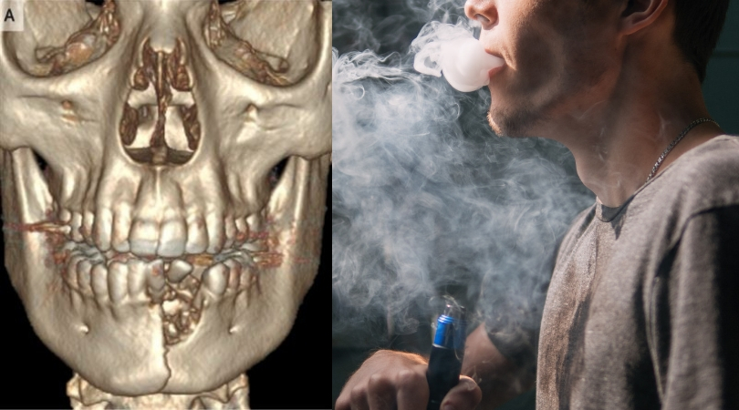 Teen’s Jaw Shatters After E-Cigarette Explodes in His Mouth