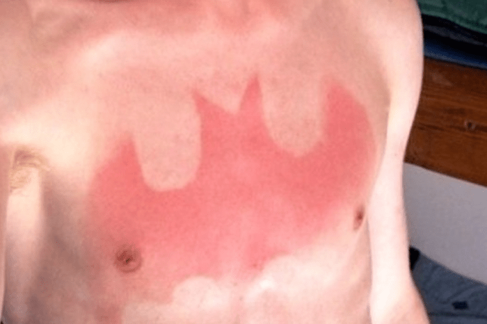 “Sunburn Tattoos” are the Newest Cool, Insanely Dumb Thing Young People are Doing