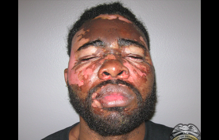Woman Fights Off Armed Man By Melting His Face Off with Hot Grease